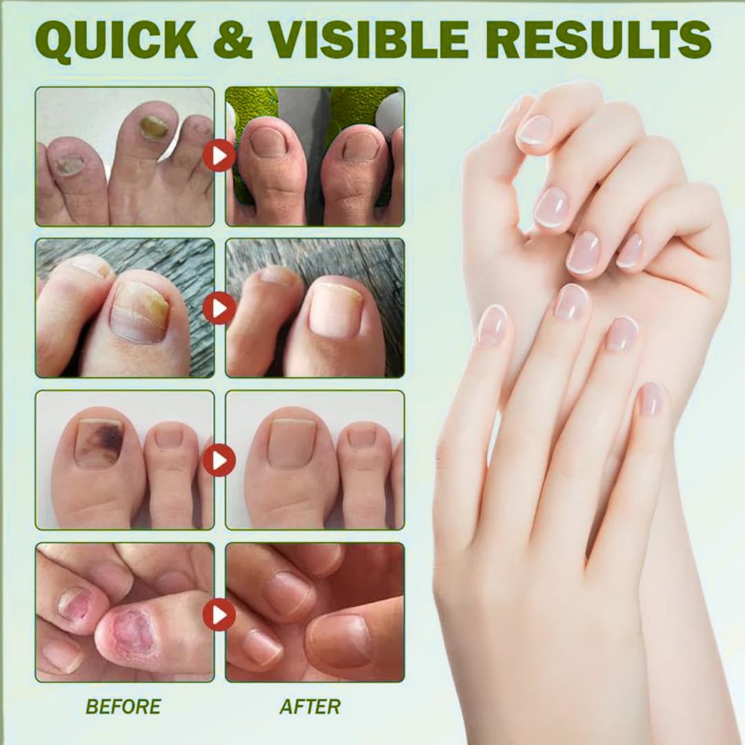 Belluvie™ Fungal Nail Patches